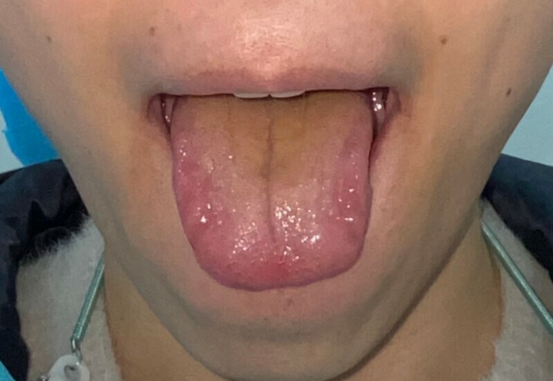 舌小帯切除術 術後